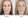 Sculptra treatment before and After Results