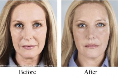 Sculptra treatment before and After Results