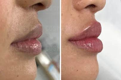Lip-filler-female-19