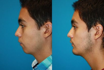 chin-augmentation-38-left-side-detail