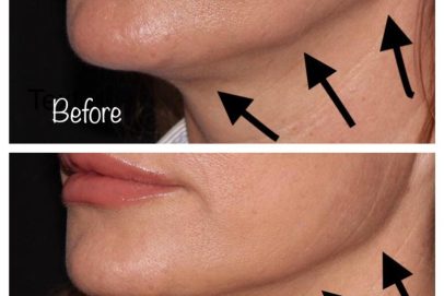 jowl-before-and-after